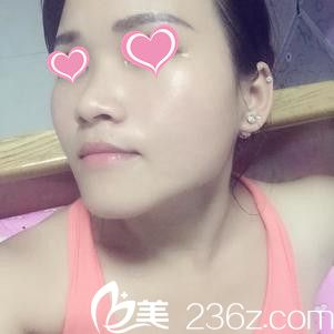 臉部剛注射完瘦臉除皺的樣子