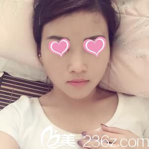 術(shù)后5天等待消腫