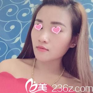 注射15天后臉型恢復(fù)情況