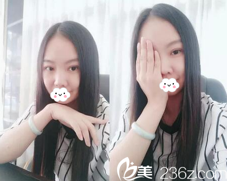 揭陽華美張旭醫(yī)生雙眼皮樣子