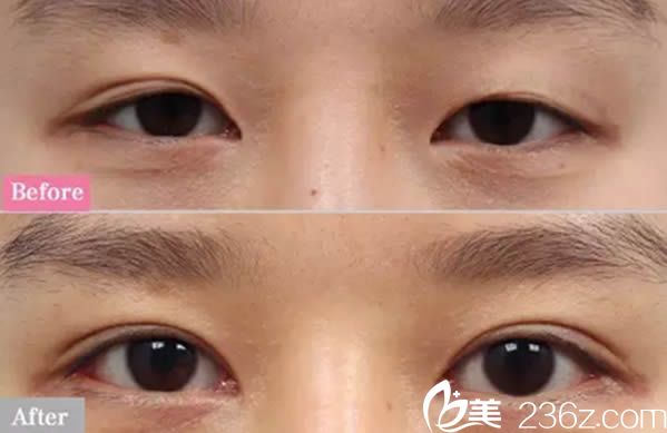 寧德華美<!--<i data=20240703-sp></i>-->生雙眼皮和開眼角案例圖 寧德華美<!--<i data=20240703-sp></i>-->生雙眼皮和開眼角案例圖