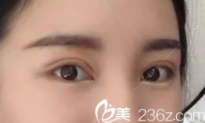 割完切開雙眼皮術(shù)后15天效果圖 割完切開雙眼皮術(shù)后15天效果圖