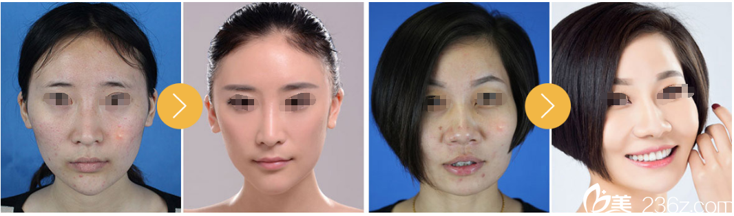 徐瑞迎醫(yī)生祛痘案例