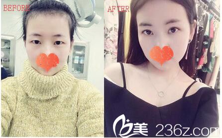 孫生雙眼皮案例 孫生雙眼皮案例