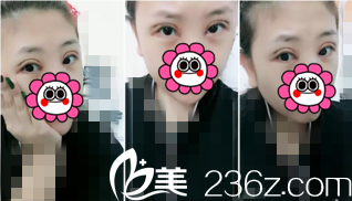 術(shù)后天樣子