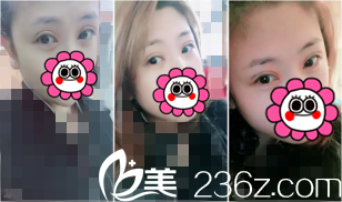 術(shù)后第八天來院拆線