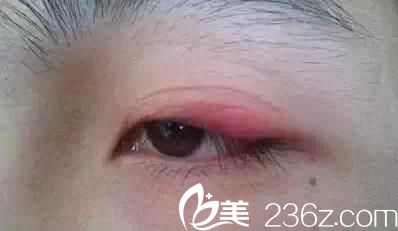 經(jīng)常帖雙眼皮貼的危害 經(jīng)常帖雙眼皮貼的危害