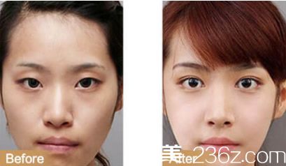 雙眼皮+開眼角案例 雙眼皮+開眼角案例