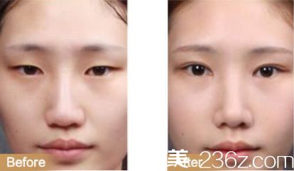 包頭華美面部綜合整形效果 包頭華美面部綜合整形效果