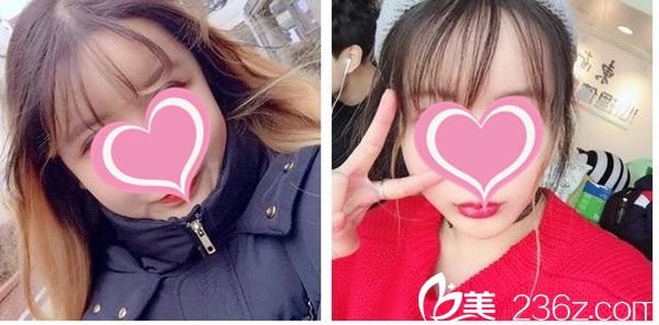 高娜英院長溶脂瘦臉案例 高娜英院長溶脂瘦臉案例