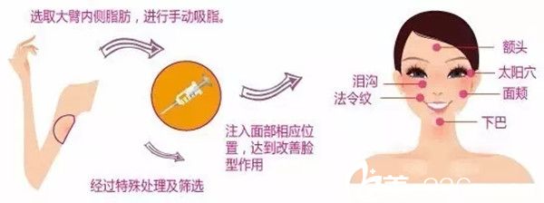 車敏秀說自體脂肪填充 車敏秀說自體脂肪填充