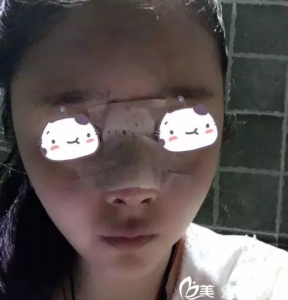 在建國(guó)整形做鼻綜合第1天