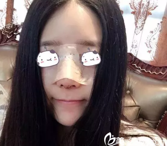 做完隆鼻手術(shù)第2天恢復(fù)照