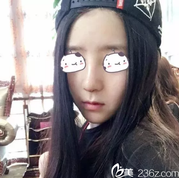 徐建國(guó)耳軟骨隆鼻手術(shù)<span style=