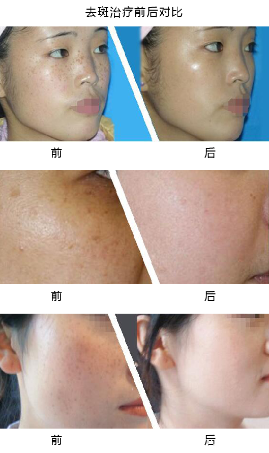 祛斑前后效果對比 祛斑前后效果對比