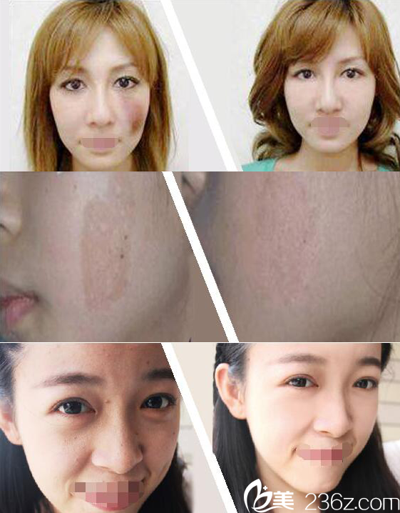 激光治療前后對(duì)比 激光治療前后對(duì)比