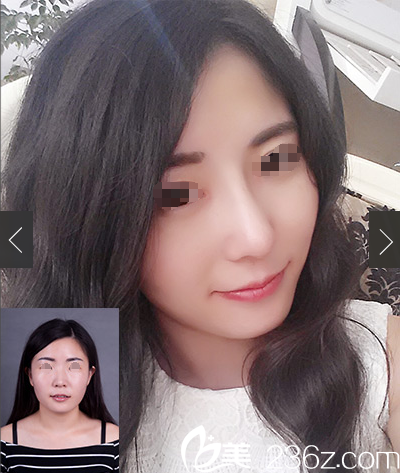 曹海峰主任隆鼻案例 曹海峰主任隆鼻案例