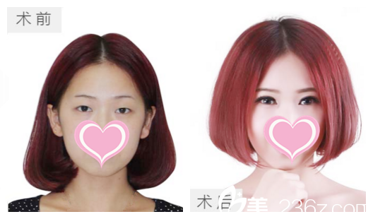 真人雙眼皮前后效果展示