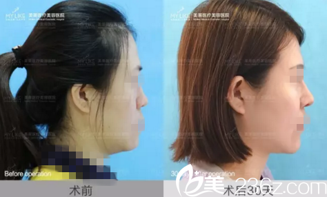 鼻部整形真人前后效果對比