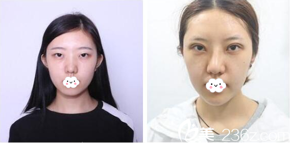 雙眼皮術(shù)前照和術(shù)后即刻效果 雙眼皮術(shù)前照和術(shù)后即刻效果