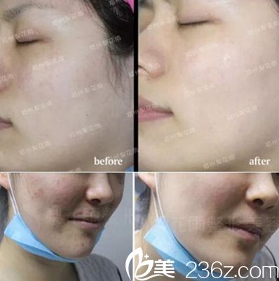 梨花雨嫩膚美容真人案例