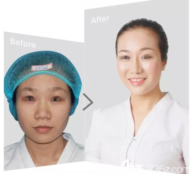 院內(nèi)員工做鼻綜合整形案例 院內(nèi)員工做鼻綜合整形案例
