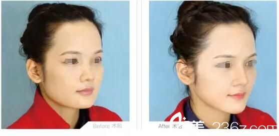 淮安華美玻尿酸注射隆鼻案例 淮安華美玻尿酸注射隆鼻案例