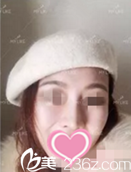 分享下我找沈陽美萊整形醫(yī)院張晨做的高挺“網(wǎng)紅鼻”全過程