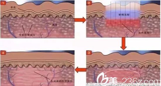 彩光嫩膚原理 彩光嫩膚原理