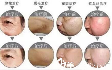 鄭州梨花雨做激光祛痘嫩膚彩光嫩膚治療效果 鄭州梨花雨做激光祛痘嫩膚彩光嫩膚治療效果