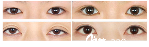 高羅鏞院長雙眼皮修復(fù)案例