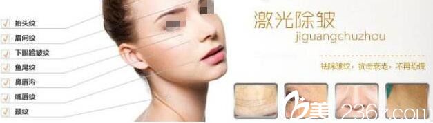 激光除皺適合面部的部位