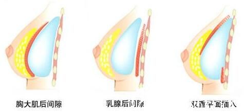 北海韓美整形醫(yī)生講解2c雙平面豐胸