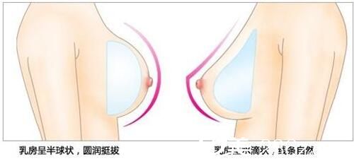 常見的兩種假體形態(tài)