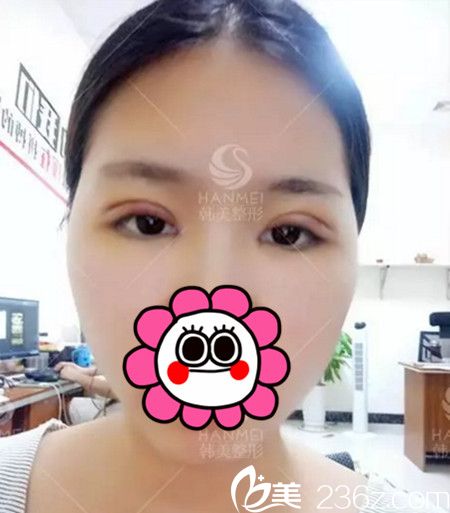 在北海韓美做雙眼皮+開眼角手術(shù)后1天
