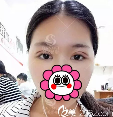 在北海韓美做雙眼皮+開眼角手術(shù)后3天