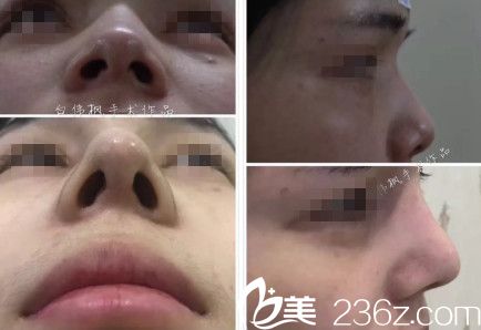 白偉楓院長鼻綜合整形案例 白偉楓院長鼻綜合整形案例