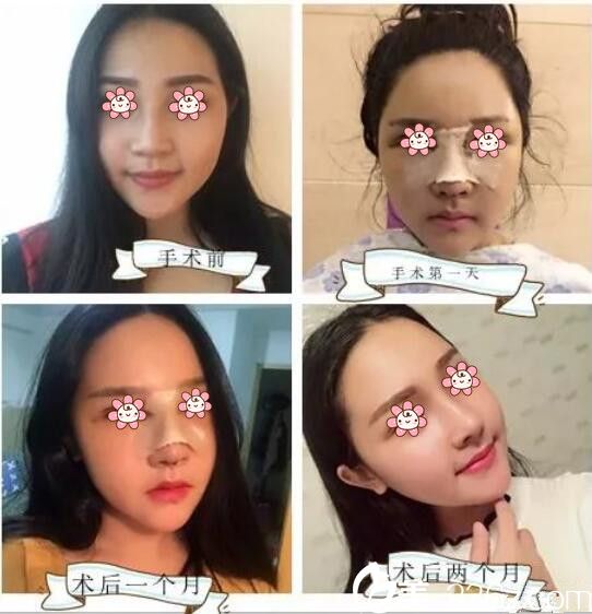 馮勛蘭自體軟骨隆鼻案例 馮勛蘭自體軟骨隆鼻案例