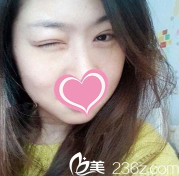 鄭州芳藝做的全切雙眼皮讓我大開電眼 術后睫毛也翹了