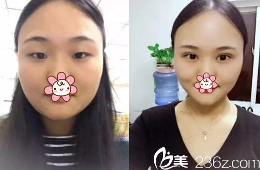 冶春梅眼部整形案例 冶春梅眼部整形案例