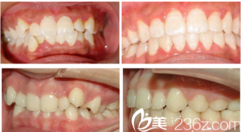合肥美奧口腔醫(yī)院袁世海牙齒正畸案例效果展示 合肥美奧口腔醫(yī)院袁世海牙齒正畸案例效果展示
