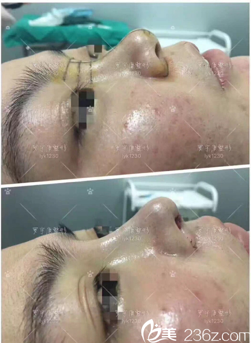 佛山華美整形<!--<i data=20240703-sp></i>-->醫(yī)生做的肋軟骨隆鼻子案例 佛山華美整形<!--<i data=20240703-sp></i>-->醫(yī)生做的肋軟骨隆鼻子案例