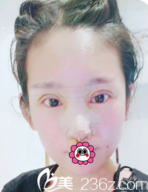 做完眼、鼻綜合整形3天后的樣子