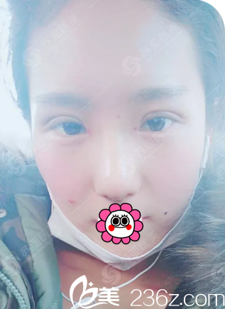眼、鼻綜合整形7天拆線后的樣子