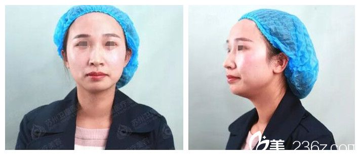 玻尿酸注射豐下巴術(shù)前 玻尿酸注射豐下巴術(shù)前