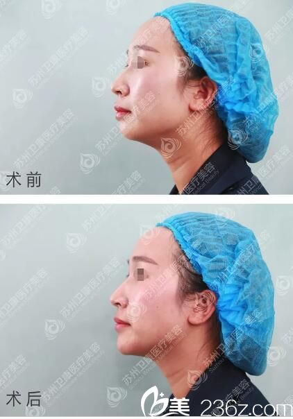 玻尿酸豐下巴術(shù)后即刻效果對比 玻尿酸豐下巴術(shù)后即刻效果對比