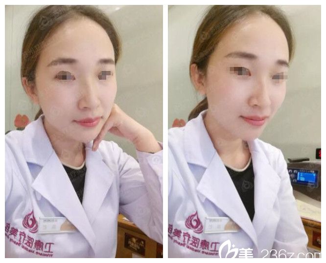 找蘇州衛(wèi)康林廣興院長注射兩支艾莉薇玻尿酸后，瞬間告別短下巴