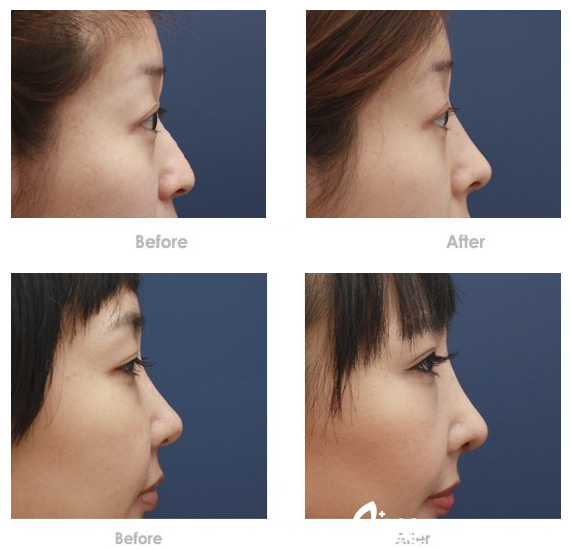 仝潤澤隆鼻案例