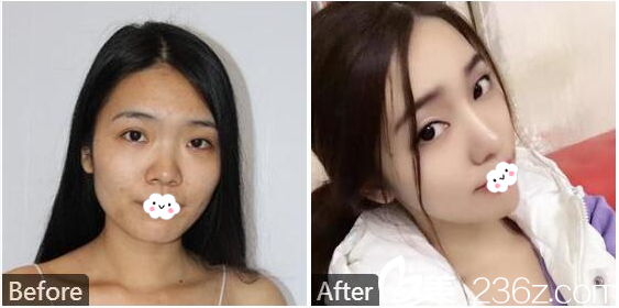 東莞締美陳星光醫(yī)生做的隆鼻案例 東莞締美陳星光醫(yī)生做的隆鼻案例