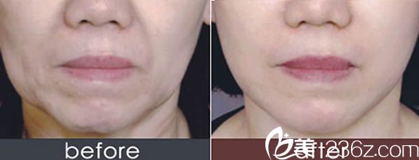 寧德華美陳建軍注射除皺前后對比案例 寧德華美陳建軍注射除皺前后對比案例